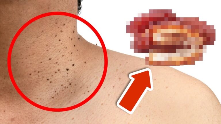 7 Common Foods That Cause Skin Tags You Never Knew About