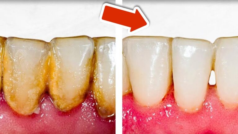 Lose Tooth Plaque Forever in Just 7 Days with These Simple Tips!