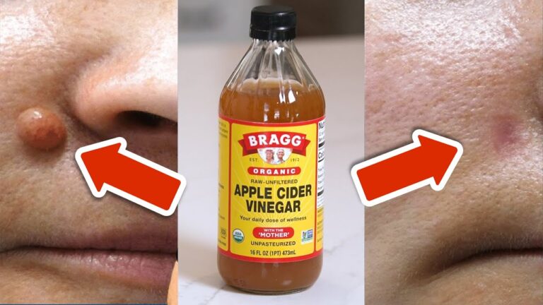 Remove Warts in 24 Hours with This 1 Simple Apple Cider Vinegar Trick!