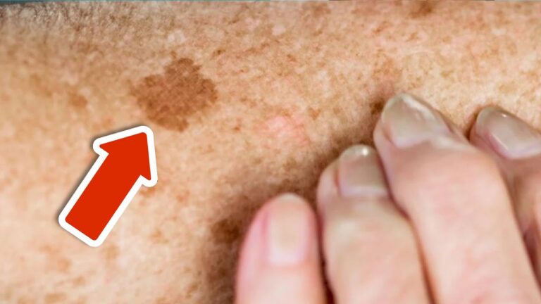 7 Vitamins That Permanently Remove Age Spots and Revitalize Your Skin!