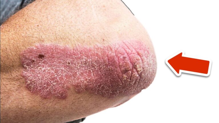 Discover 7 Ways This Vitamin Can Permanently Eliminate Psoriasis!
