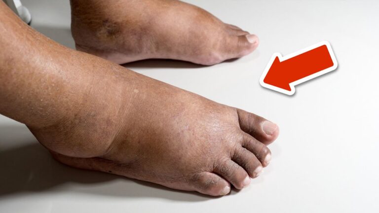 7 Amazing Vitamins to Reduce Swelling in Feet and Legs Naturally!