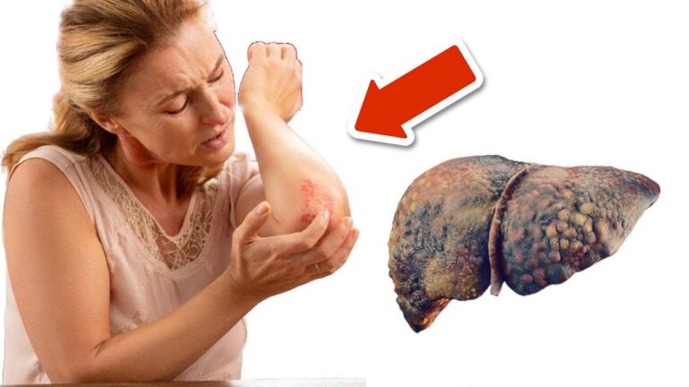 5 Warning Signs of Liver Issues You Can Spot on Your Skin and Legs
