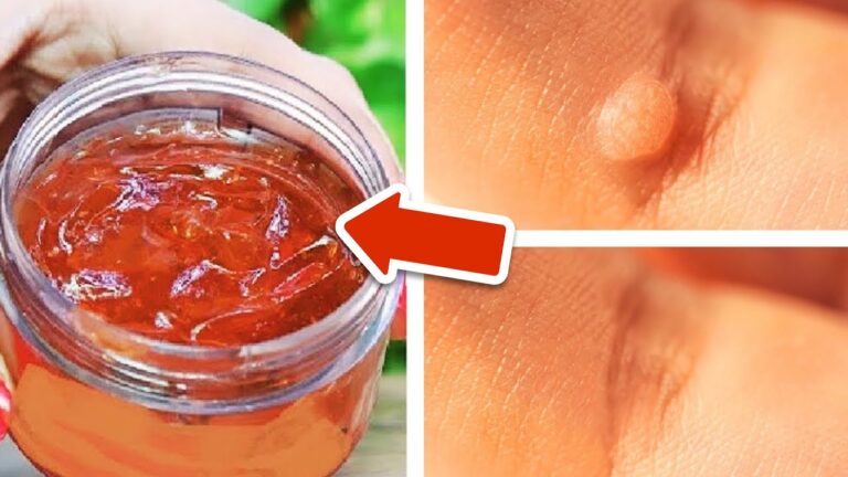 Remove 1 Wart Forever with This Simple Trick You Need to Try!