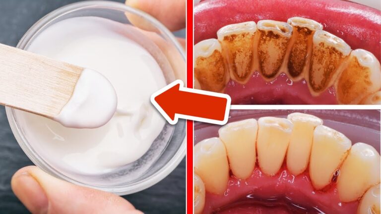 7 Best Home Remedies to Remove Tartar, Cavities, and Plaque Effortlessly
