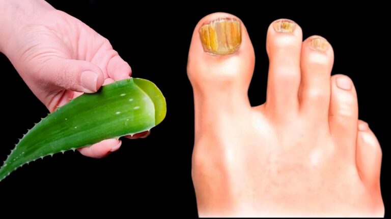Erase Nail Fungus Fast: 5 Amazing Benefits of Aloe You Need to Know Now! 🌿