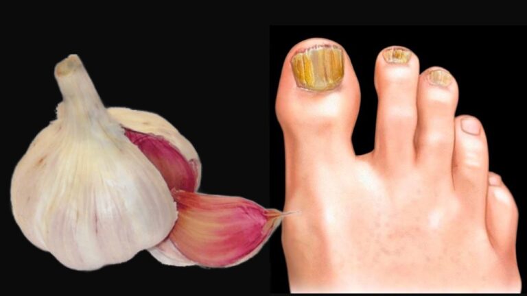 Eliminate Nail Fungus Fast with This 5-Star Natural Remedy! Discover How!