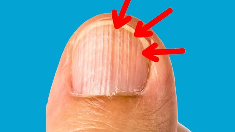 Uncover 5 Surprising Causes of Vertical Nail Lines You Never Knew!